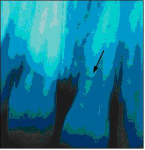RootFracture